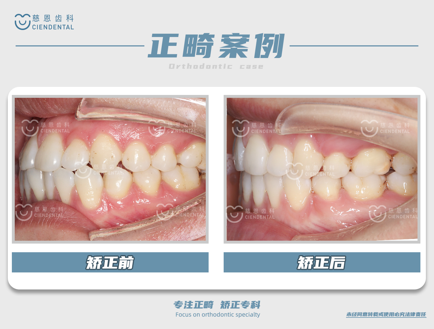 杨林医生牙齿矫正案例