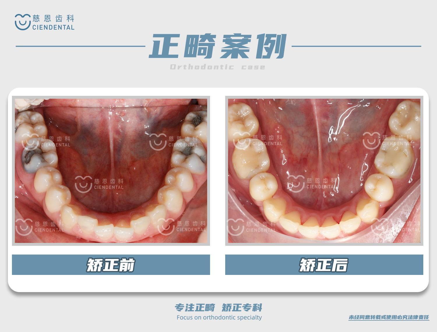 杨林医生牙齿矫正案例 杨林医生牙齿矫正案例