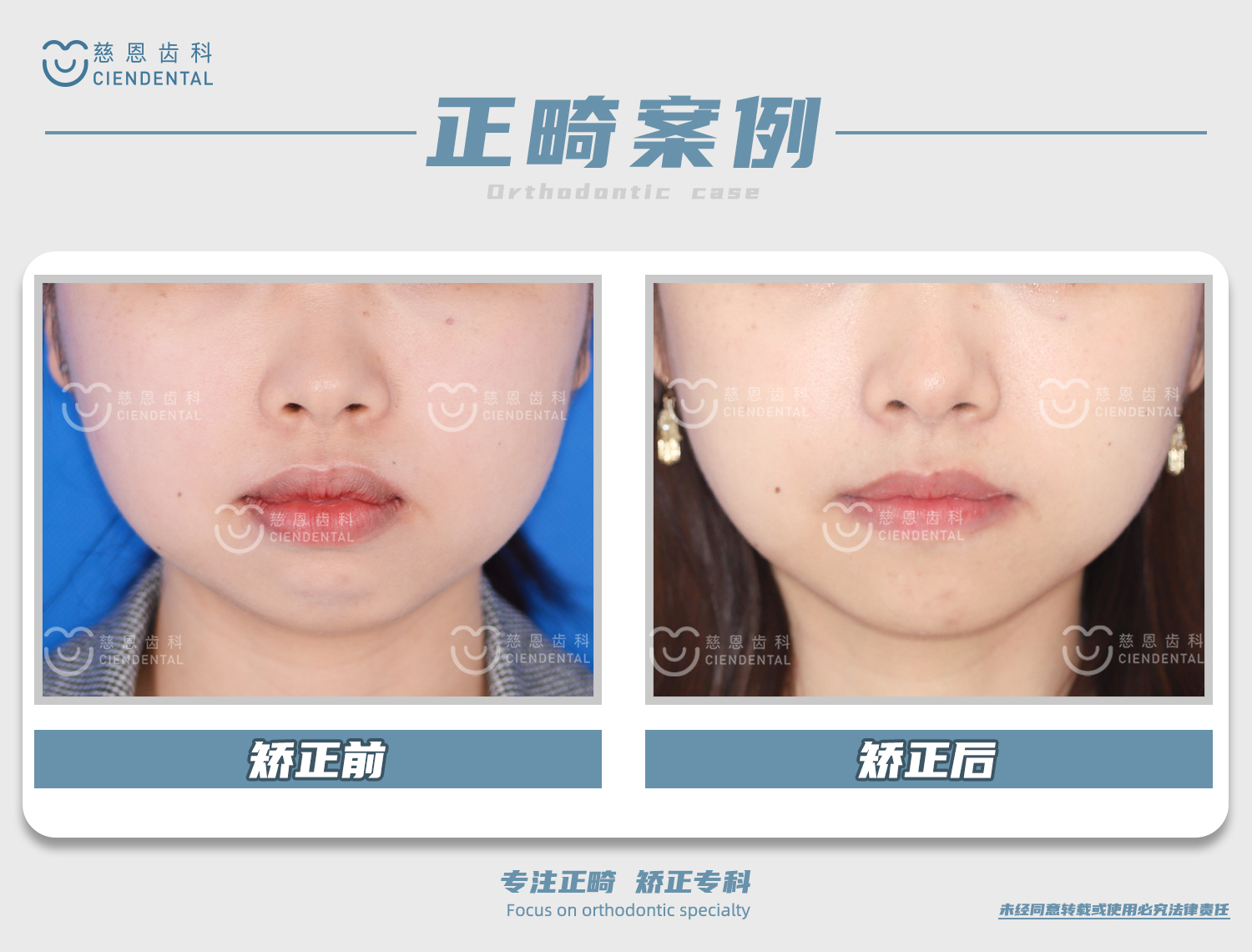 杨林医生牙齿矫正案例 杨林医生牙齿矫正案例
