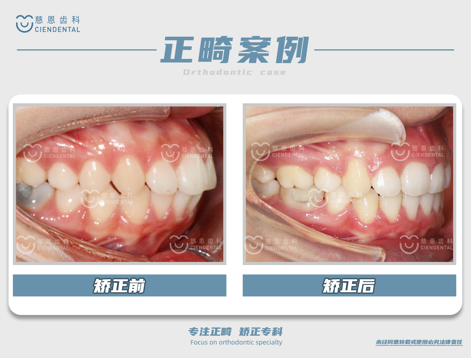 杨林医生牙齿矫正案例 杨林医生牙齿矫正案例