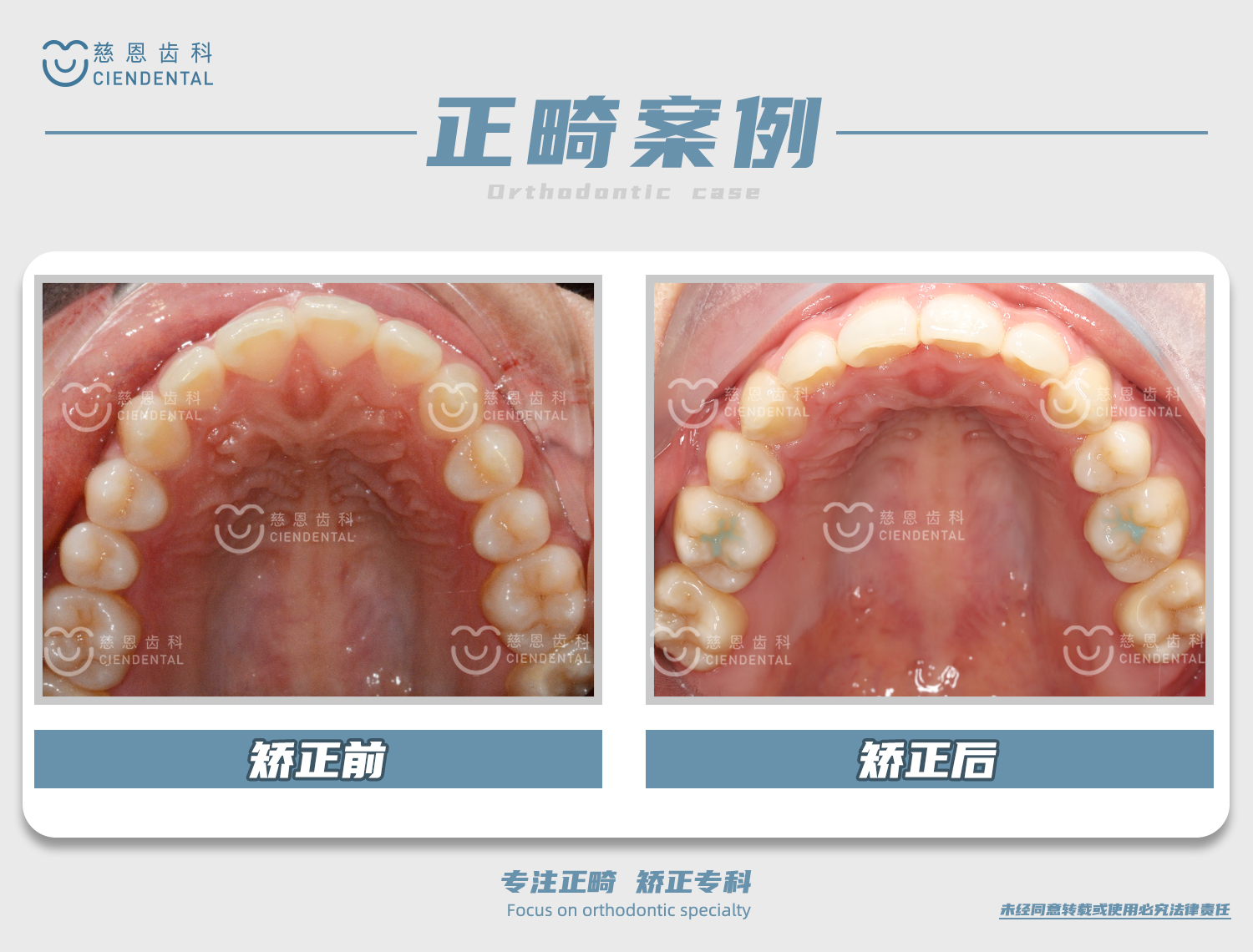 杨林医生牙齿矫正案例 杨林医生牙齿矫正案例