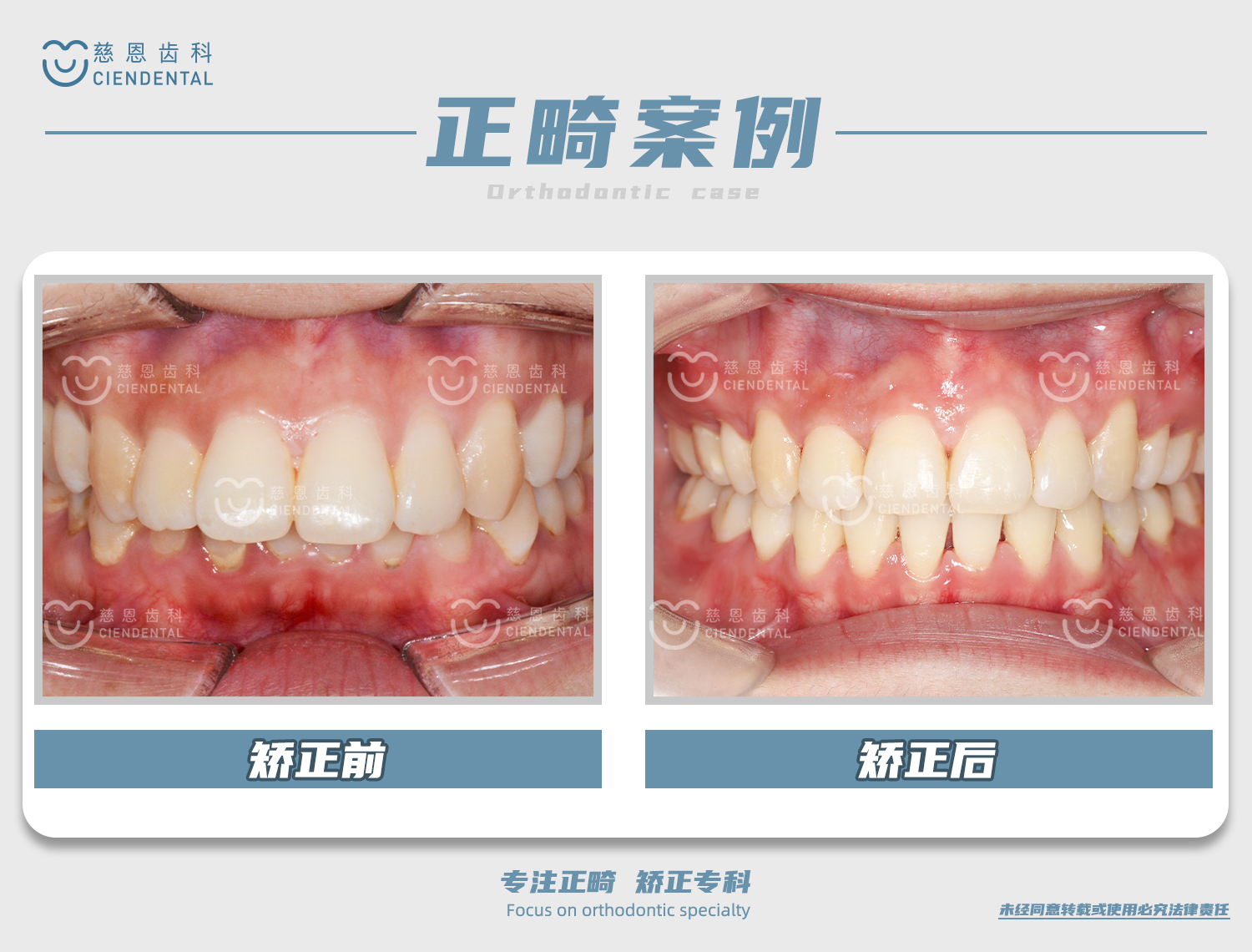 杨林医生牙齿矫正案例