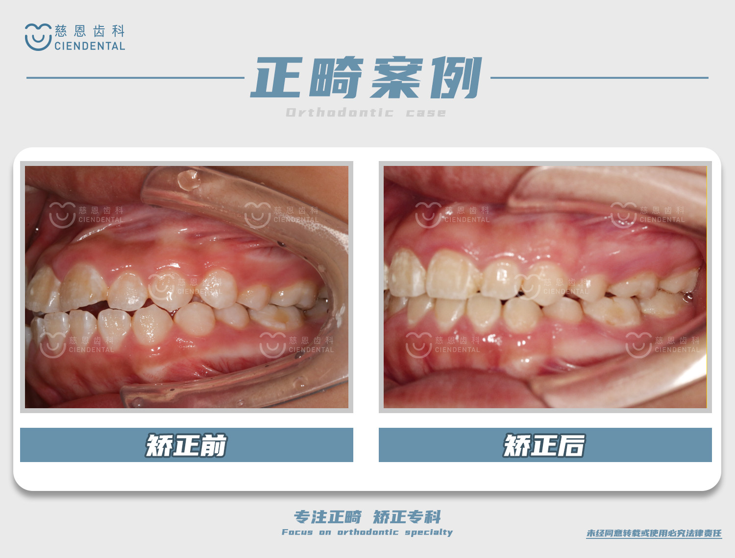 张雄英医生牙齿矫正案例