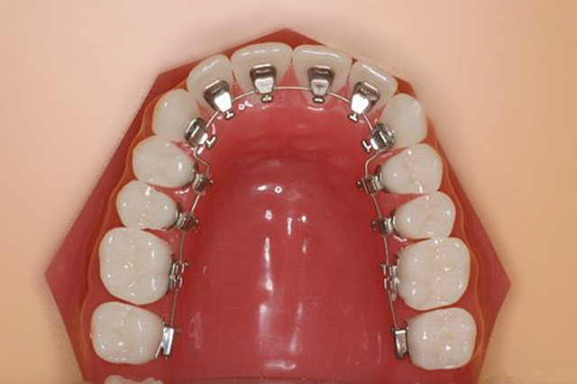 深圳牙齿矫正技术