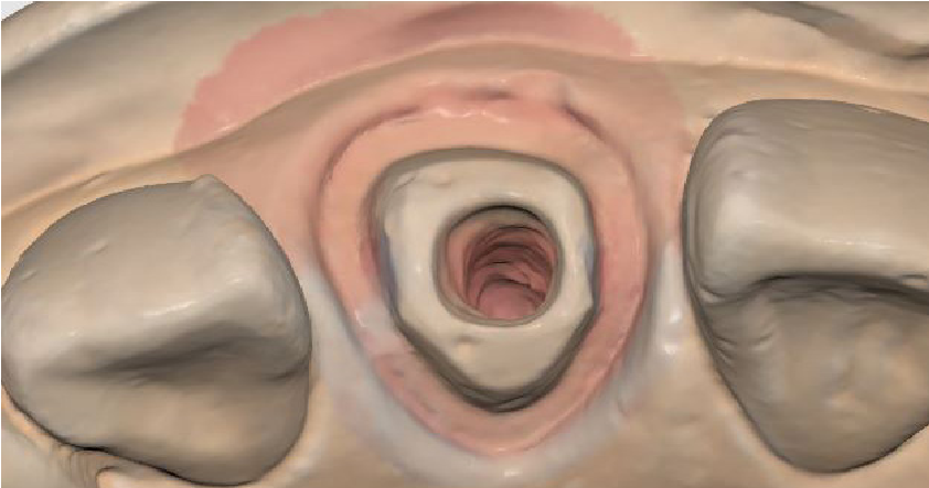 桩核扫描