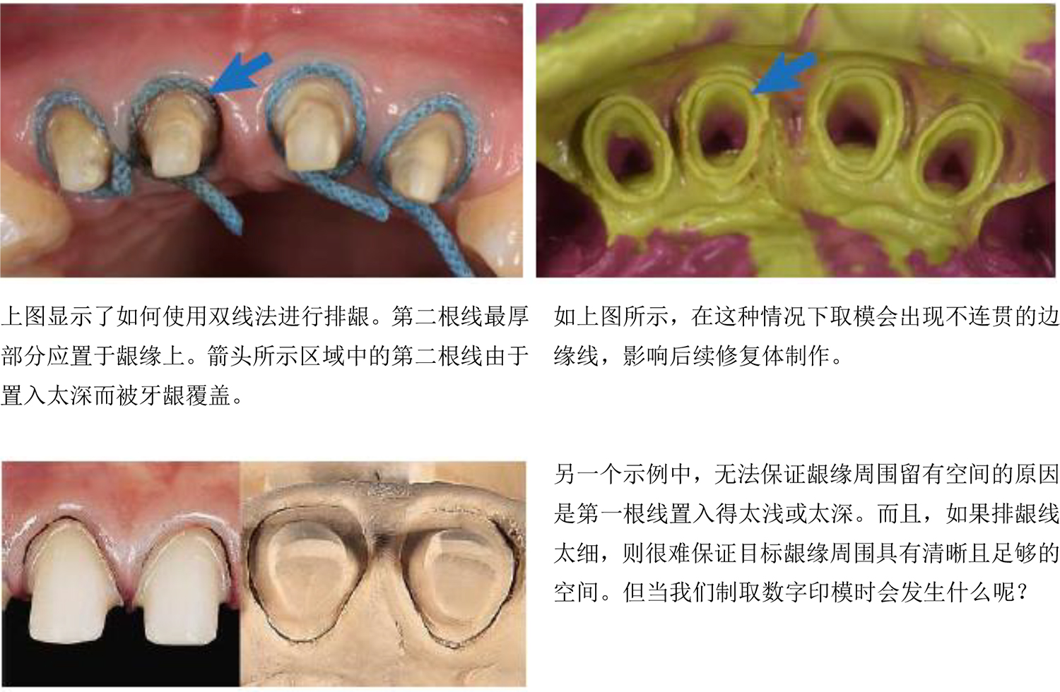 i500-如何使用口内扫描仪在修复治疗中获取清晰的龈下边缘数据