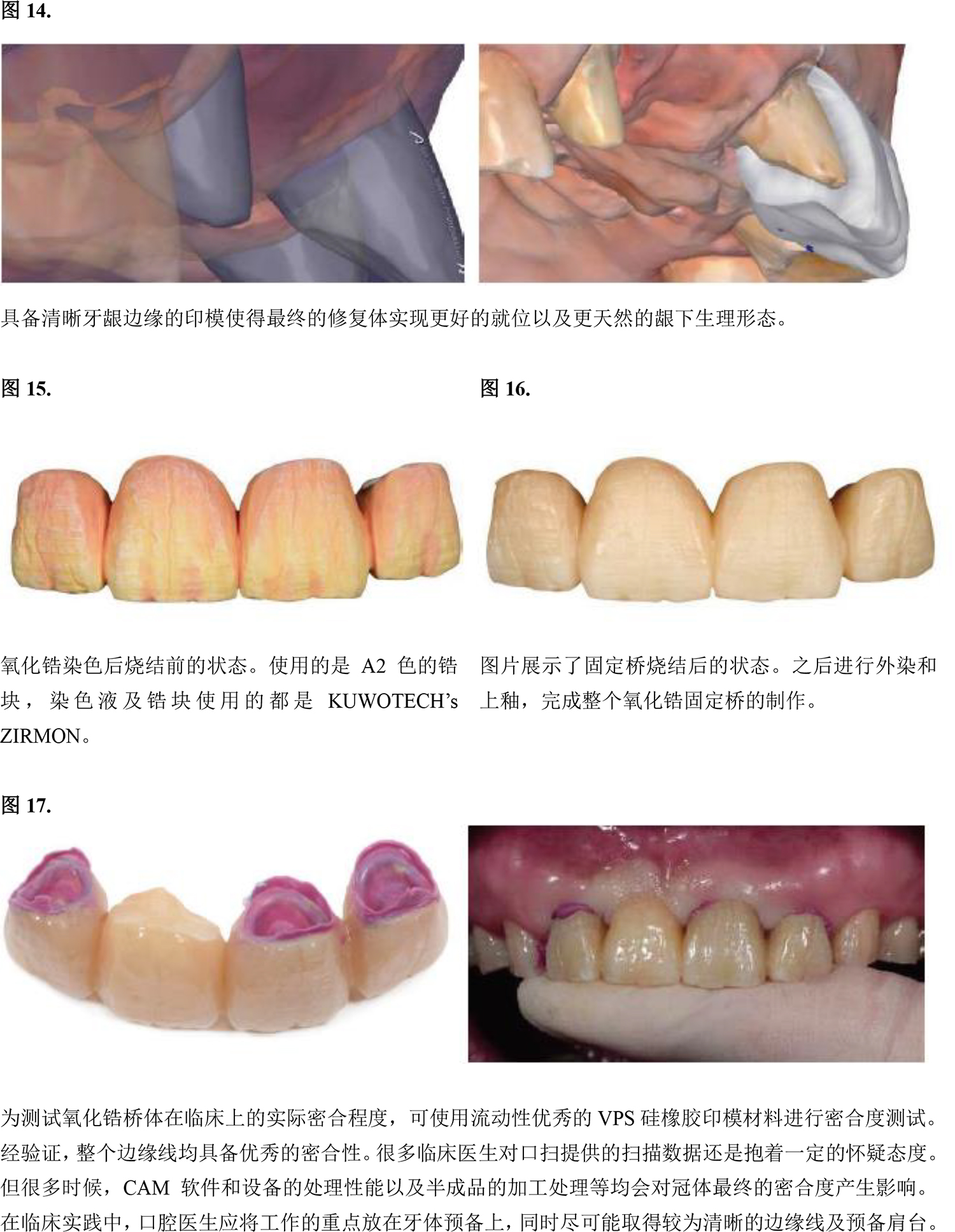 i500-如何使用口內掃描儀在修復治療中獲取清晰的齦下邊緣數據