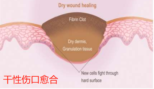 亚澳科普角 | 水凝胶敷料-上