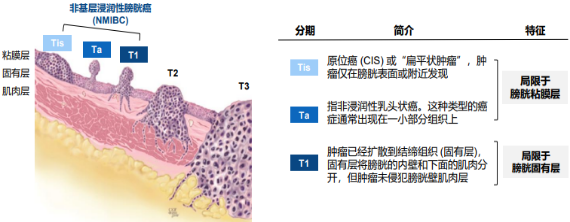 2021年非肌层浸润性膀胱癌（NMIBC）诊疗行业市场需求前景预测及投资建议规划评估预测