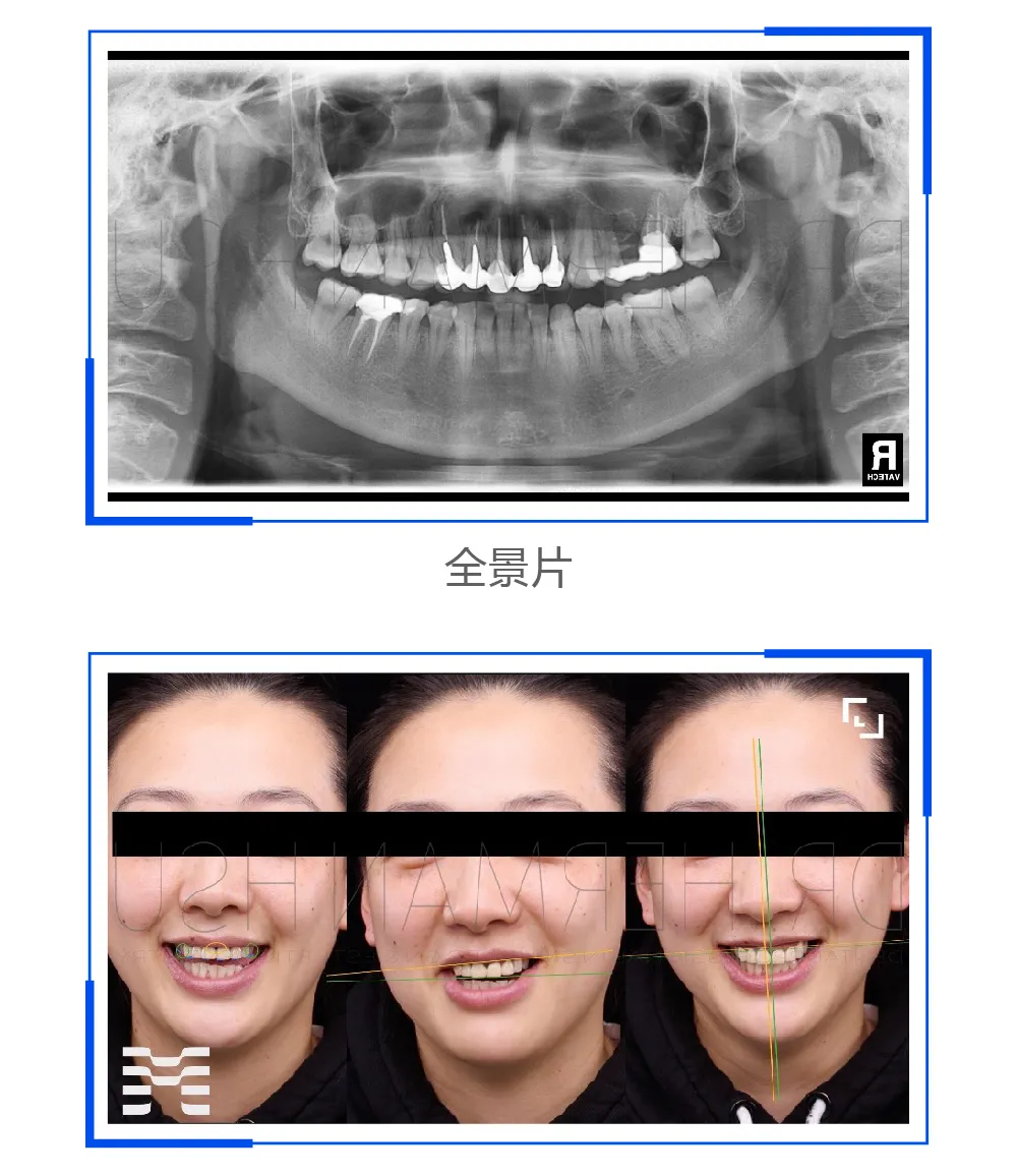 【病例报告】前牙美学的二次修复设计