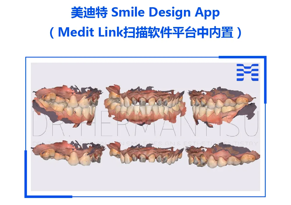 【病例报告】前牙美学的二次修复设计