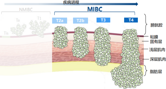 2021年肌层浸润性膀胱癌（MIBC）诊疗行业市场分析及竞争战略研究