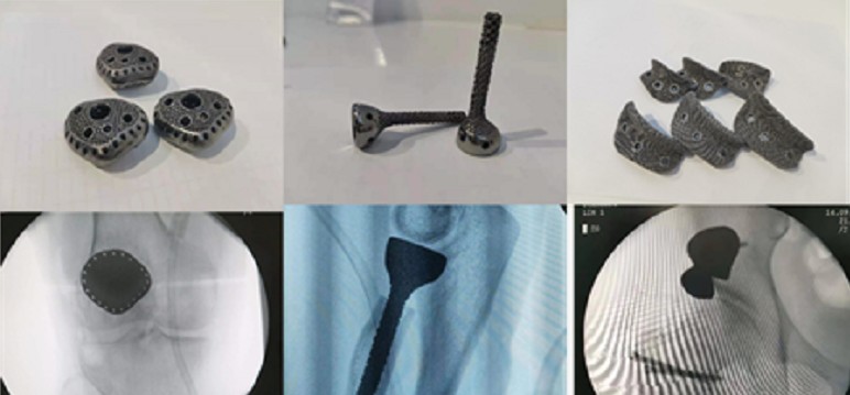 赛隆团队助力完成世界首例电子束3D打印金属钽人工椎体临床应用研究