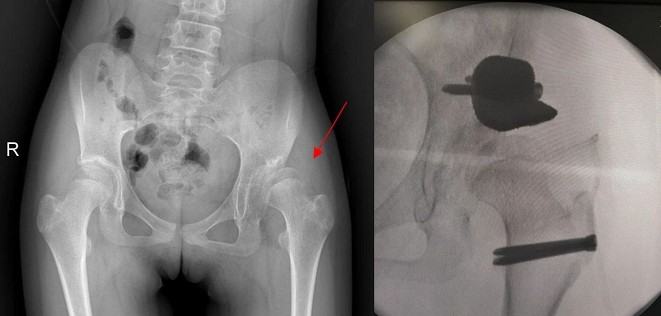 广州赛隆SEBM个性化金属钽垫块实现青少年DDH髋臼侧骨缺损精准治疗