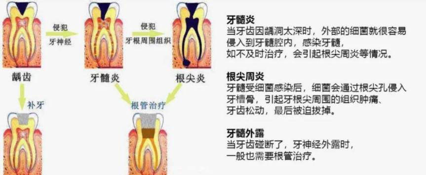 【普朗特口腔】对抗龋齿有绝招，是补牙，还是根管治疗？
