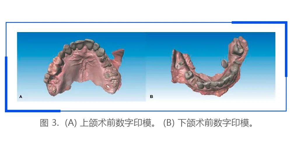 【病例报告】使用术前口内扫描和数字化设计完成全牙弓种植临床即刻修复