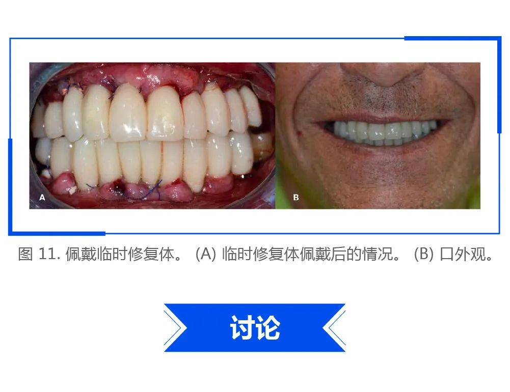 【病例报告】使用术前口内扫描和数字化设计完成全牙弓种植临床即刻修复