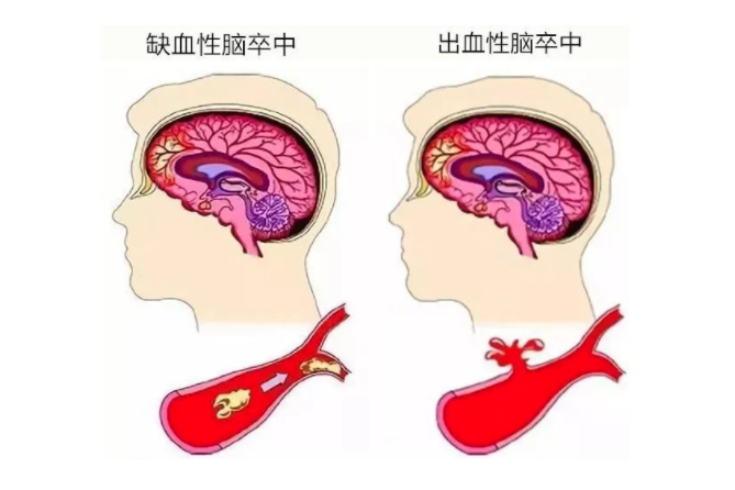 世界卒中日 | 关注心房颤，预防脑卒中