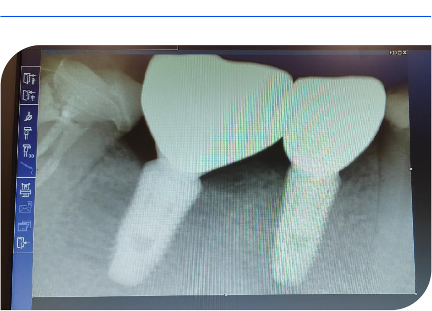【病例报告】反颌患者双侧后牙三单位种植病例