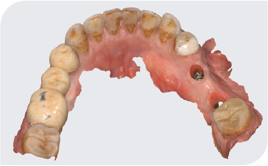 【病例报告】反颌患者双侧后牙三单位种植病例