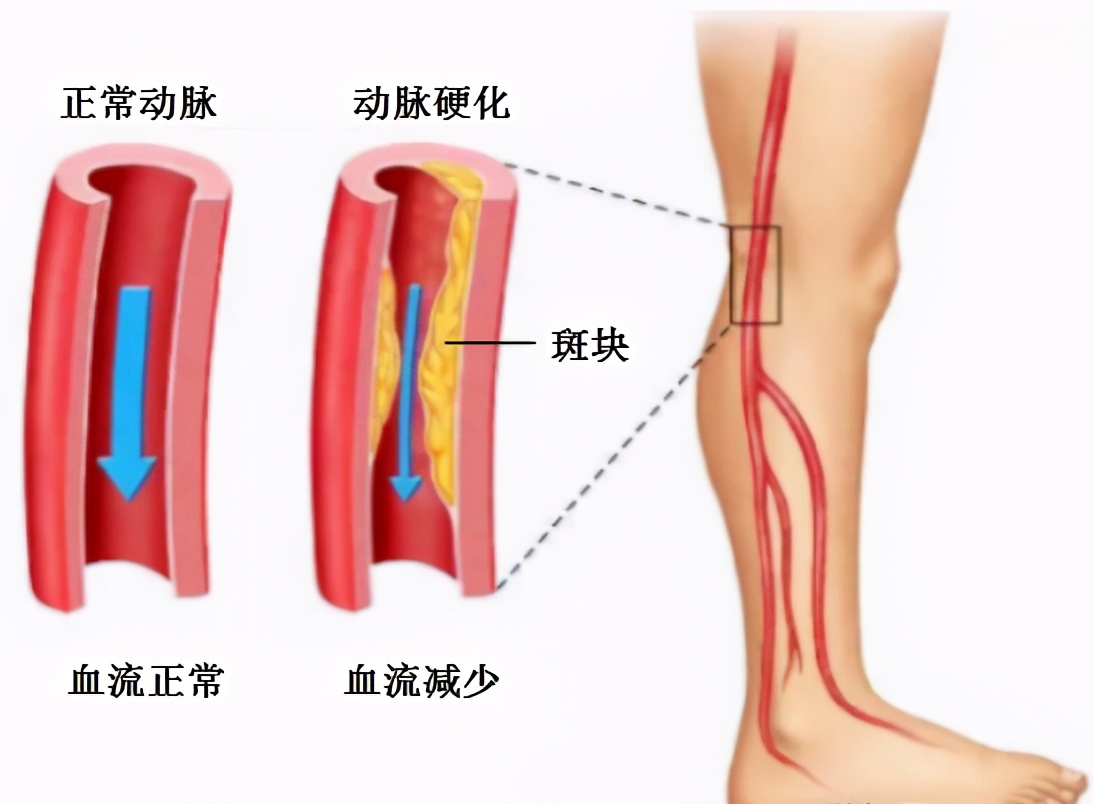 健康生活-保住我们运输生命线-“血管”！