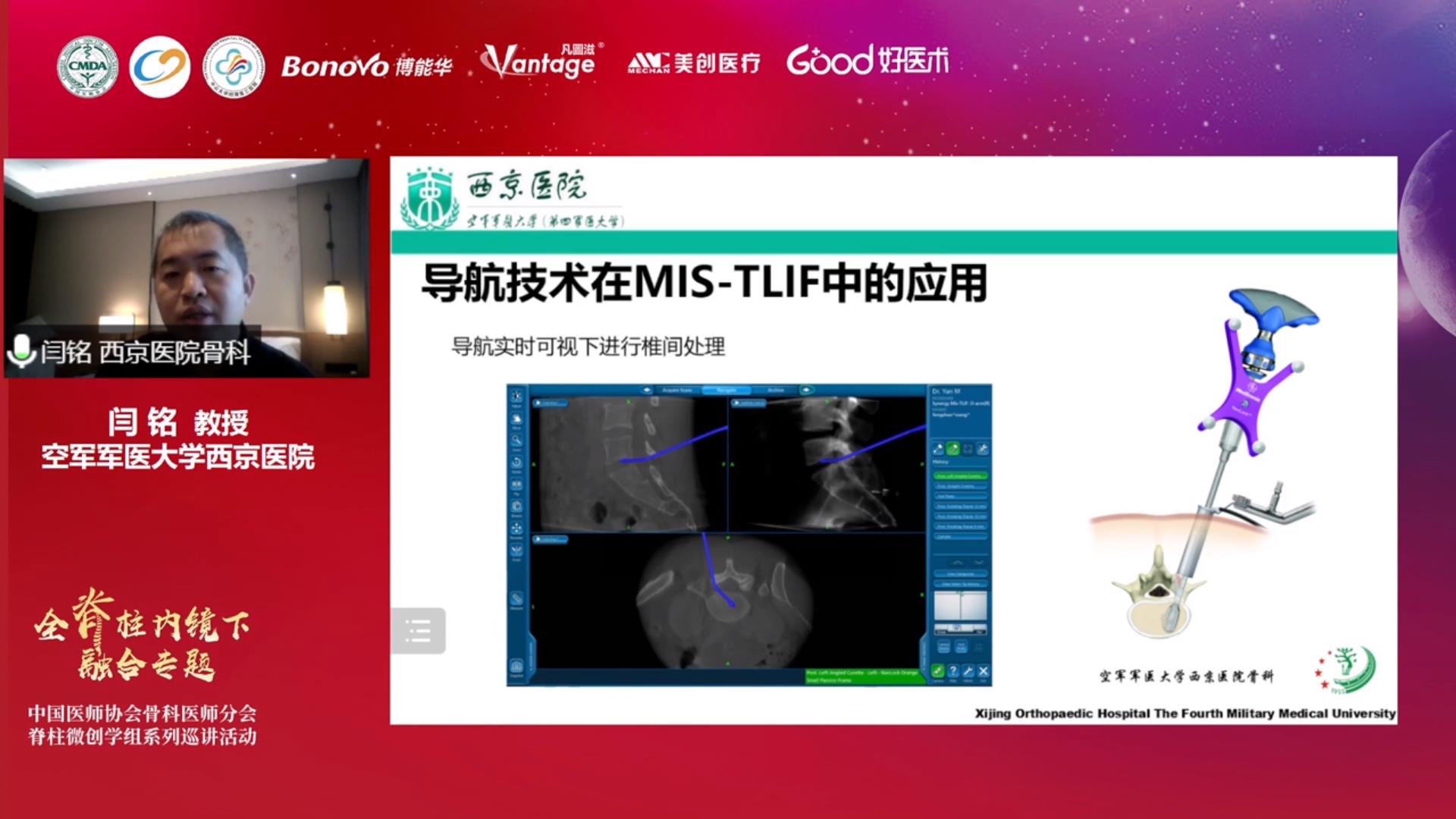 会议报道 | 中国医师协会骨科医师分会脊柱微创学组系列巡讲活动全脊柱内镜下融合专题（宝鸡站）