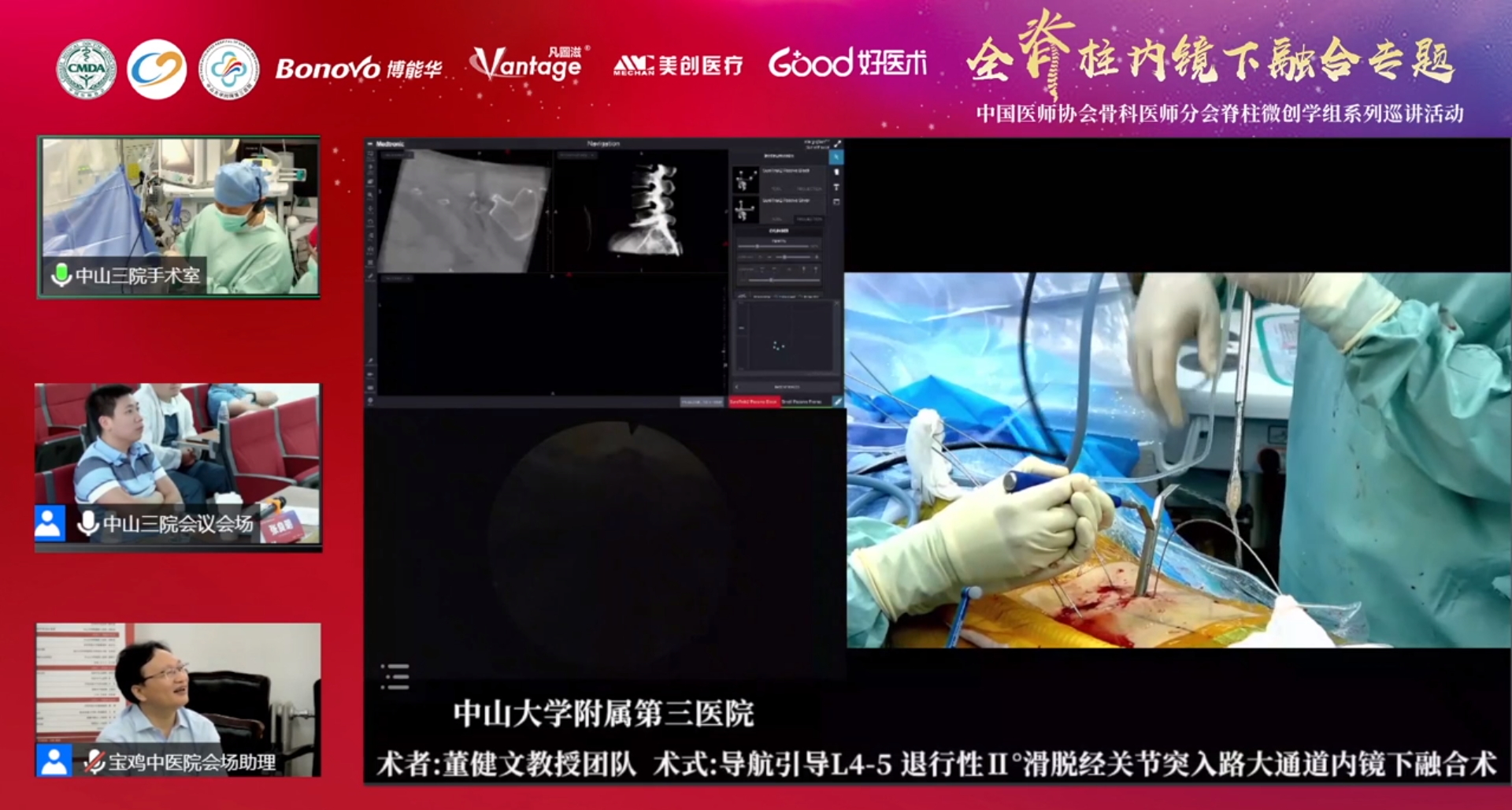 会议报道 | 中国医师协会骨科医师分会脊柱微创学组系列巡讲活动全脊柱内镜下融合专题（宝鸡站）