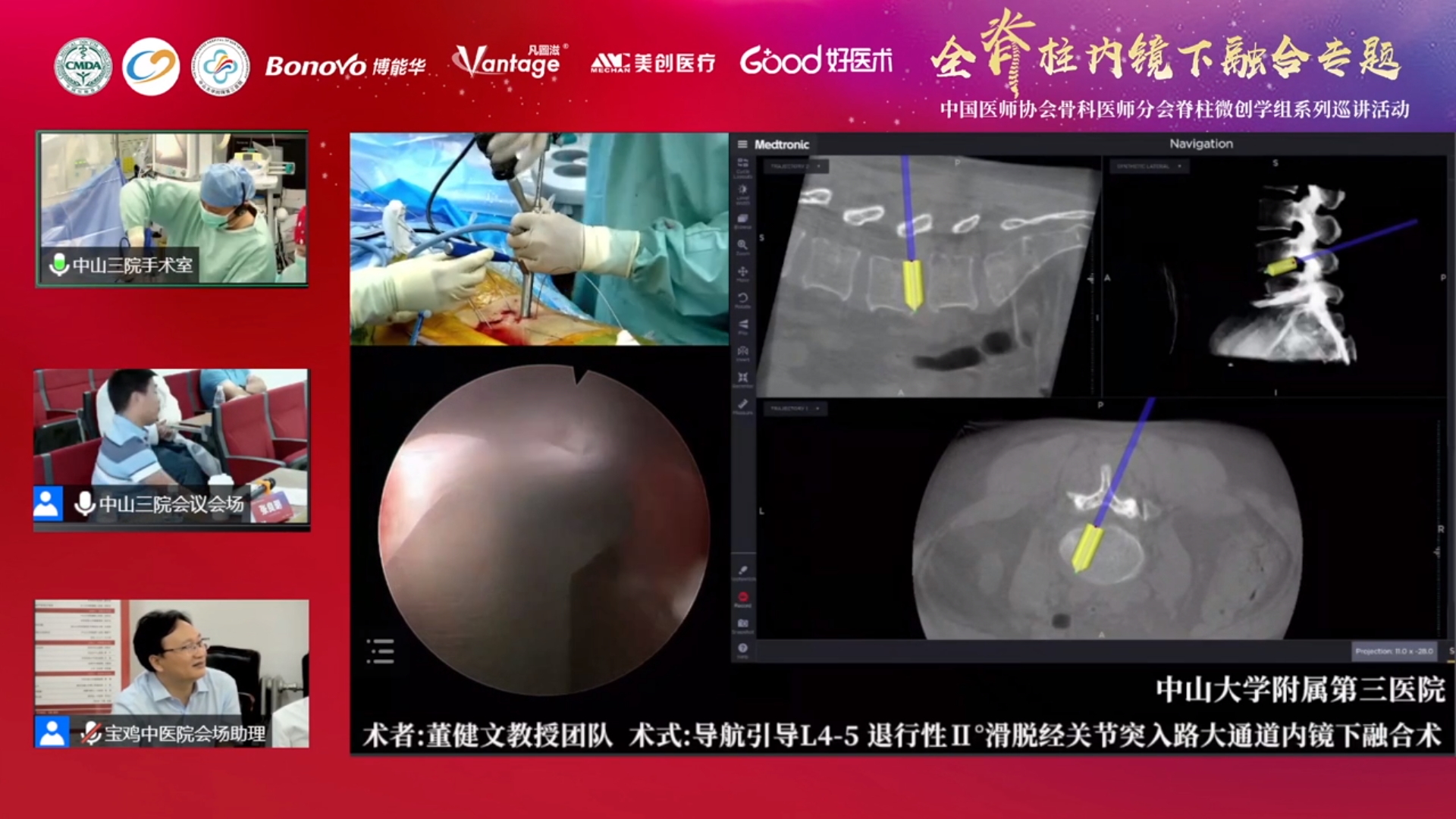 会议报道 | 中国医师协会骨科医师分会脊柱微创学组系列巡讲活动全脊柱内镜下融合专题（宝鸡站）