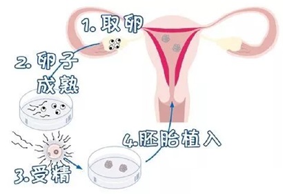 试管婴儿的过程