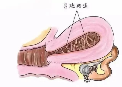 反复的宫腔粘连该如何治疗,才能“一治永逸”? 反复的宫腔粘连该如何治疗,才能“一治永逸”?