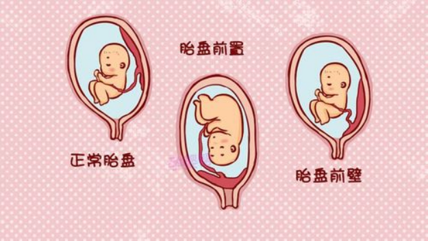 宫颈机能不全的鉴别诊断