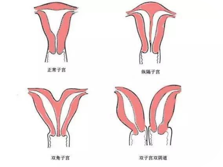 宫颈机能不全的鉴别诊断