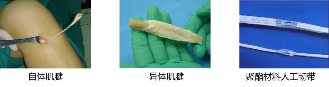【运医科普】前交叉韧带重建移植物专题 【运医科普】前交叉韧带重建移植物专题