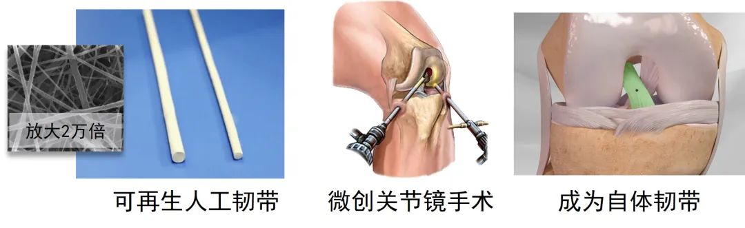 【运医科普】前交叉韧带重建移植物专题 【运医科普】前交叉韧带重建移植物专题