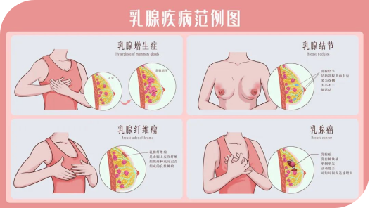 乳腺结节一定会发展成乳腺癌吗?认识它,远离它! 乳腺结节一定会发展成乳腺癌吗?认识它,远离它!