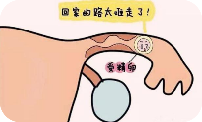 试管婴儿的五个步骤 试管婴儿的五个步骤