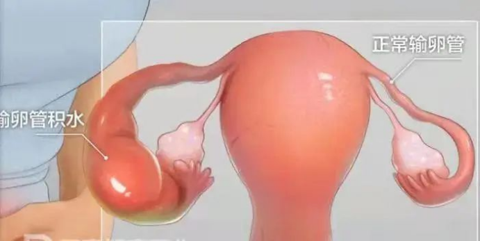 输卵管积水做试管婴儿需要注意什么? 输卵管积水做试管婴儿需要注意什么?