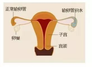 输卵管积水做试管婴儿需要注意什么? 输卵管积水做试管婴儿需要注意什么?