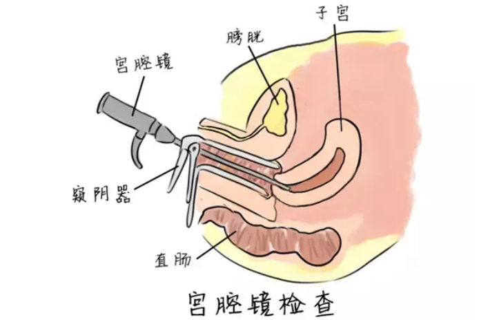 为什么医生要我做宫腔镜？