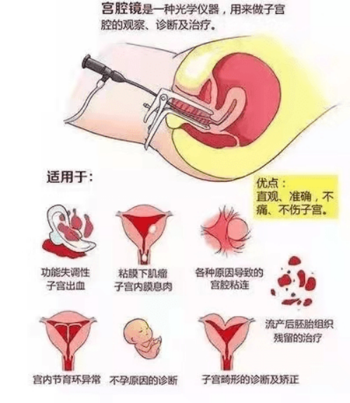 为什么医生要我做宫腔镜？