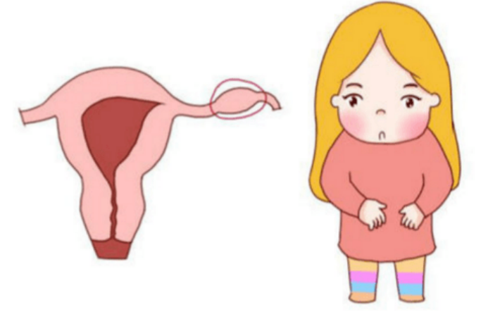 做试管婴儿可以避免宫外孕吗? 做试管婴儿可以避免宫外孕吗?