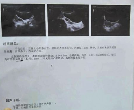 经历生化、宫外孕后,泰国三代试管,一次成功得男宝 经历生化、宫外孕后,泰国三代试管,一次成功得男宝