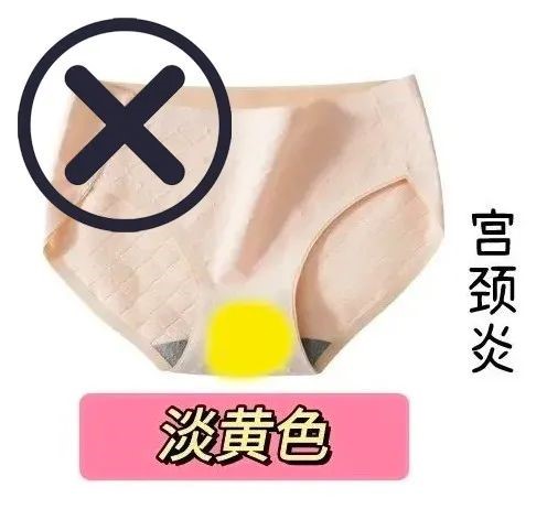 女生的白带,到底什么样的才算「正常」? 女生的白带,到底什么样的才算「正常」?