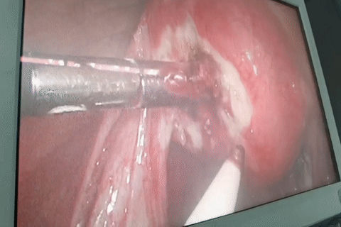 比宫颈妊娠、腹腔妊娠还要罕见的异位妊娠,你能想到吗? 比宫颈妊娠、腹腔妊娠还要罕见的异位妊娠,你能想到吗?