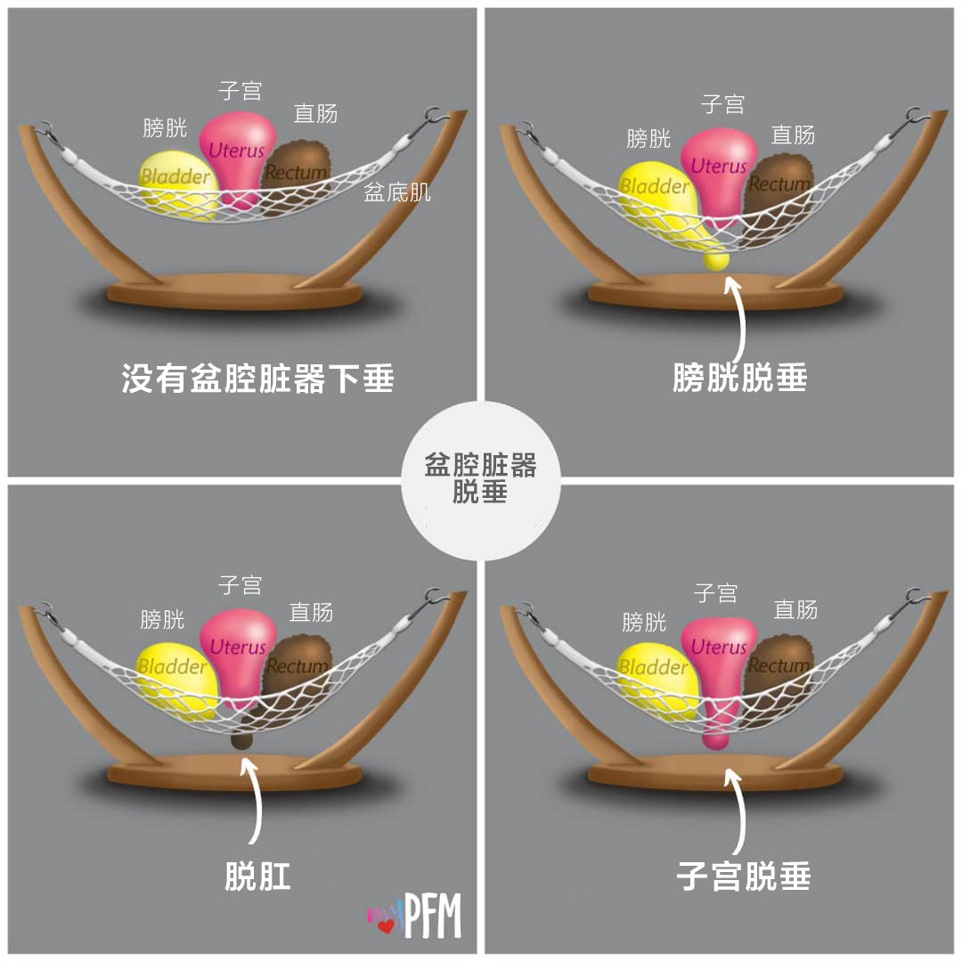 产后骨盆修复,是如何一步步掏空你的钱包 产后骨盆修复,是如何一步步掏空你的钱包