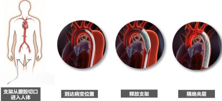 2023年主动脉介入治疗医疗器械、心血管介入器械行业细分产品市场发展规模前景预测及投资战略规划可行性研究预测