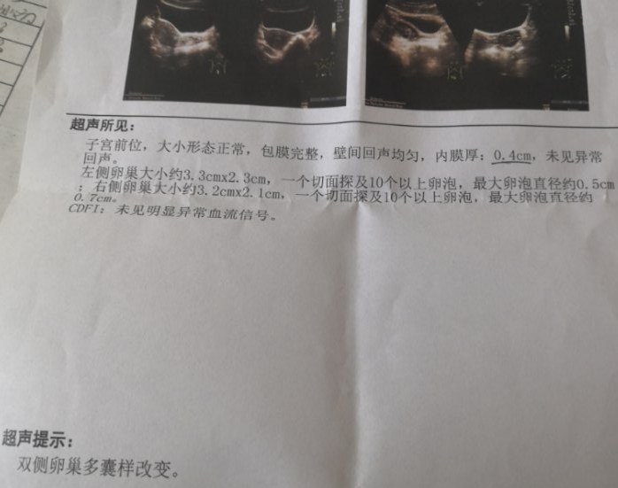 多囊久备不孕,减重14斤后,试管婴儿一次成功 多囊久备不孕,减重14斤后,试管婴儿一次成功