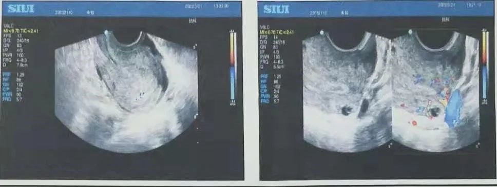 比宫颈妊娠、腹腔妊娠还要罕见的异位妊娠,你能想到吗? 比宫颈妊娠、腹腔妊娠还要罕见的异位妊娠,你能想到吗?