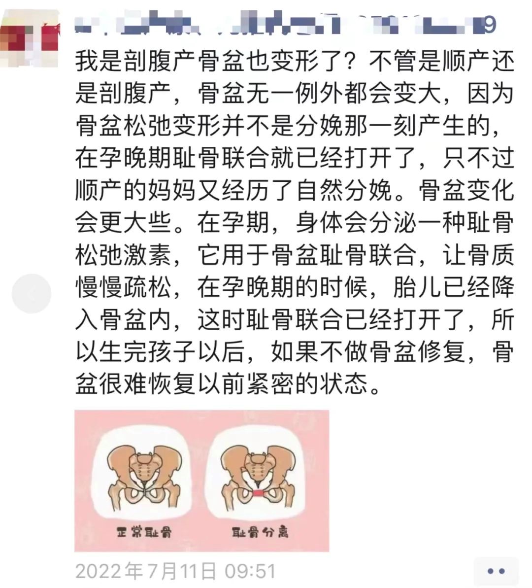 产后骨盆修复,是如何一步步掏空你的钱包 产后骨盆修复,是如何一步步掏空你的钱包