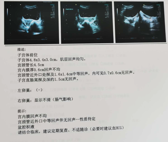妇检发现阴道后穹窿破裂口深达肌层!患者却说没有诱因? 妇检发现阴道后穹窿破裂口深达肌层!患者却说没有诱因?